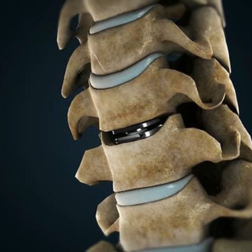 Artificial Disc Replacement at Stavya