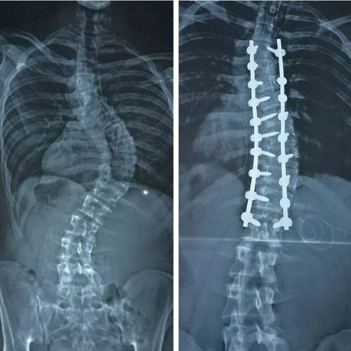 Spinal Deformity Correction