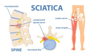 Sciatica 101: Symptoms, Causes, and Relief Tips