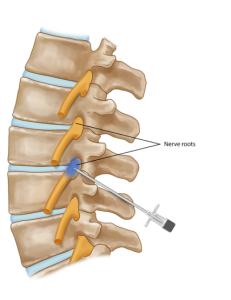 Nerve root block